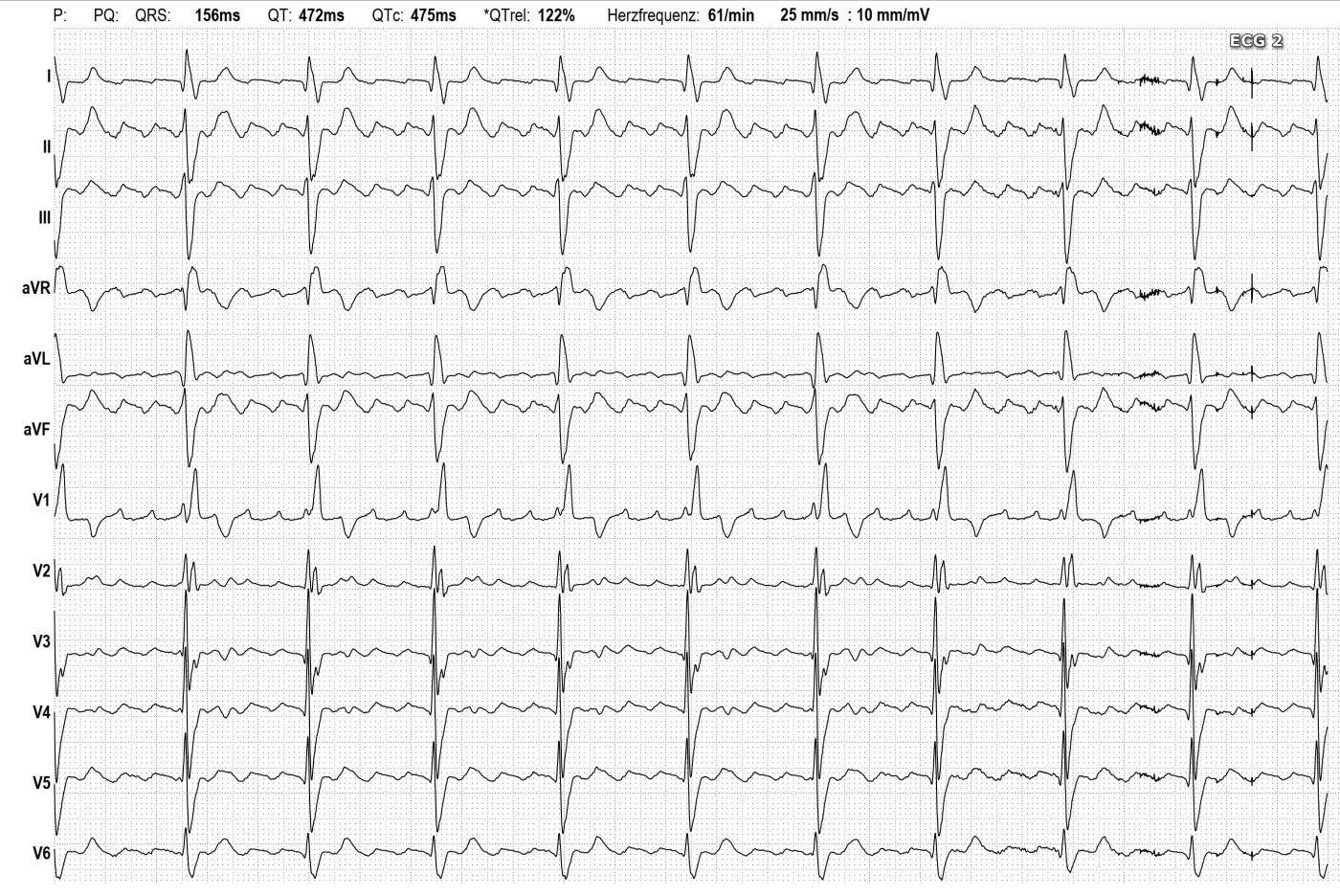 atypical-atrial-flutter-ecg-guru-instructor-resources